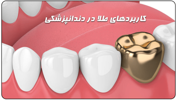 استفاده از طلا در دندانپزشکی